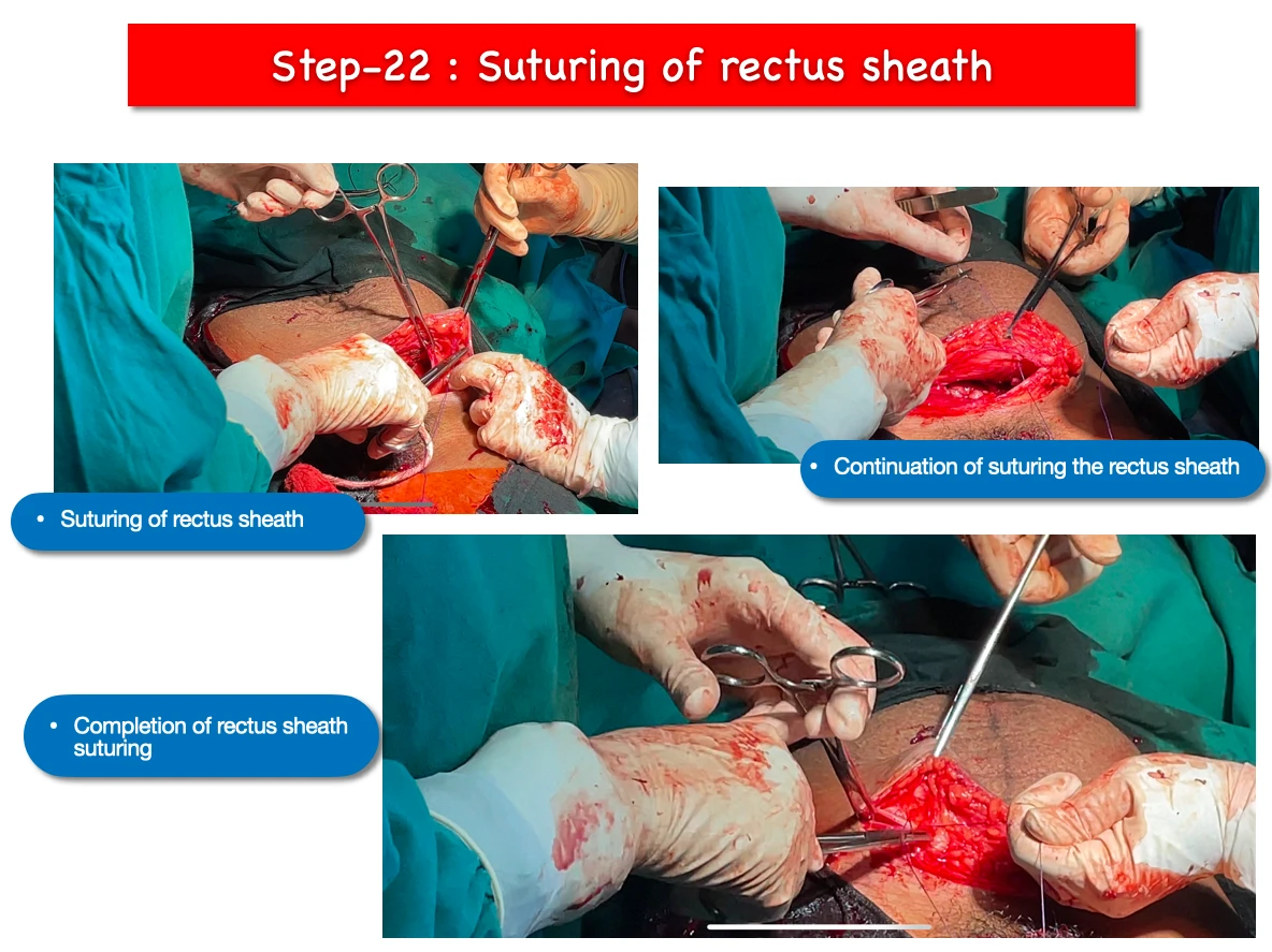 LSCS step 22